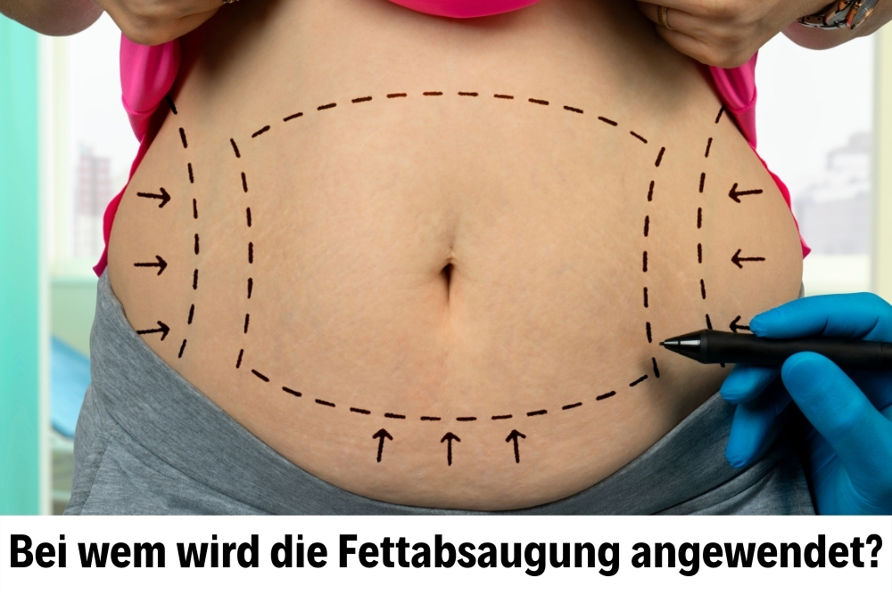 Fettabsaugung