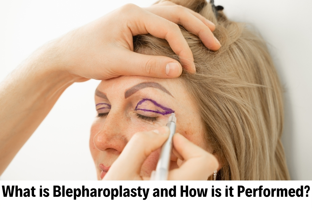 Blepharoplasty