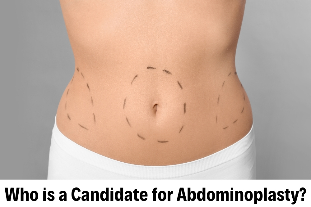 Abdominoplasty