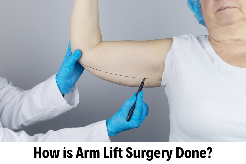 Arm Lift Surgery (Brachioplasty)