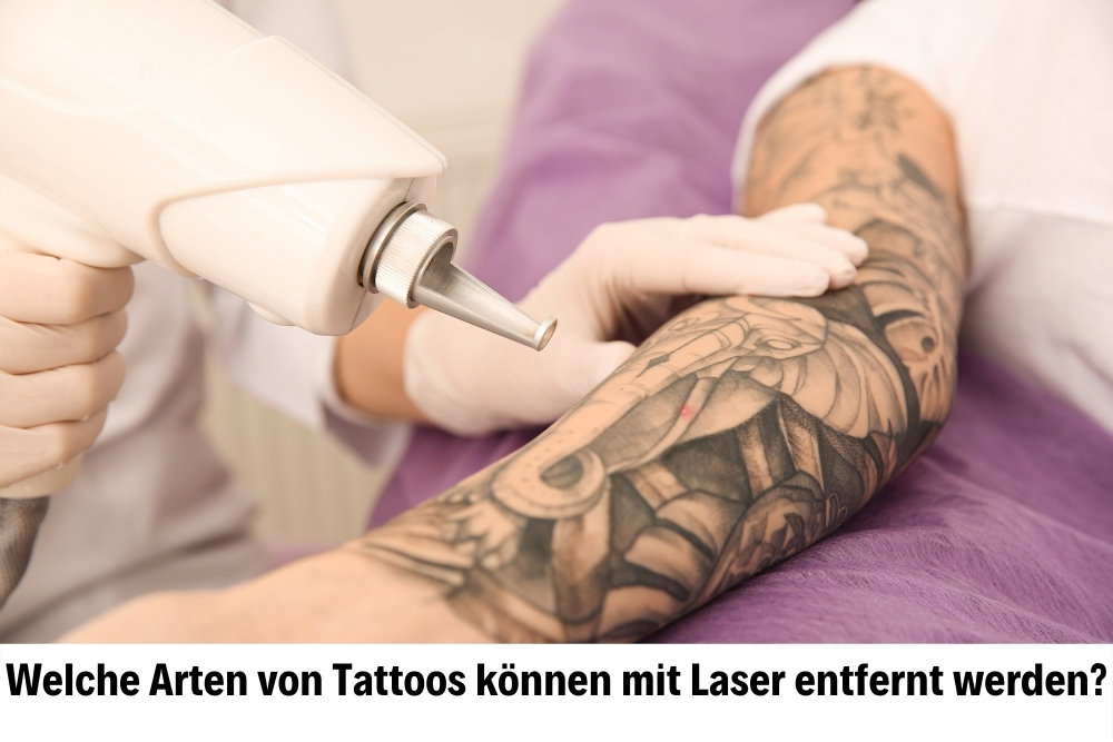 Laser Tattoo Removal