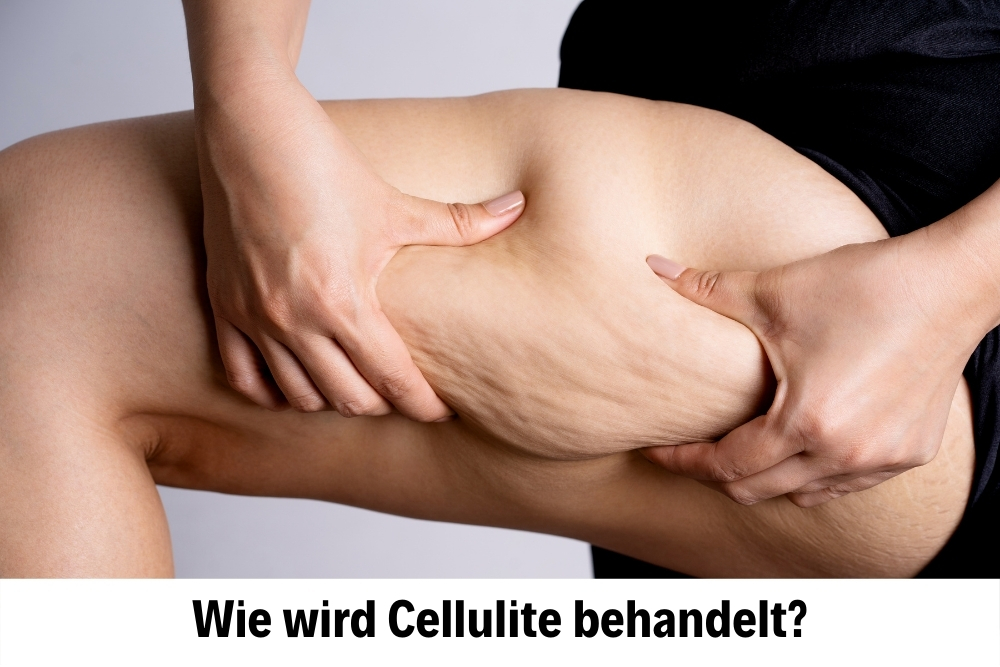 Cellulite