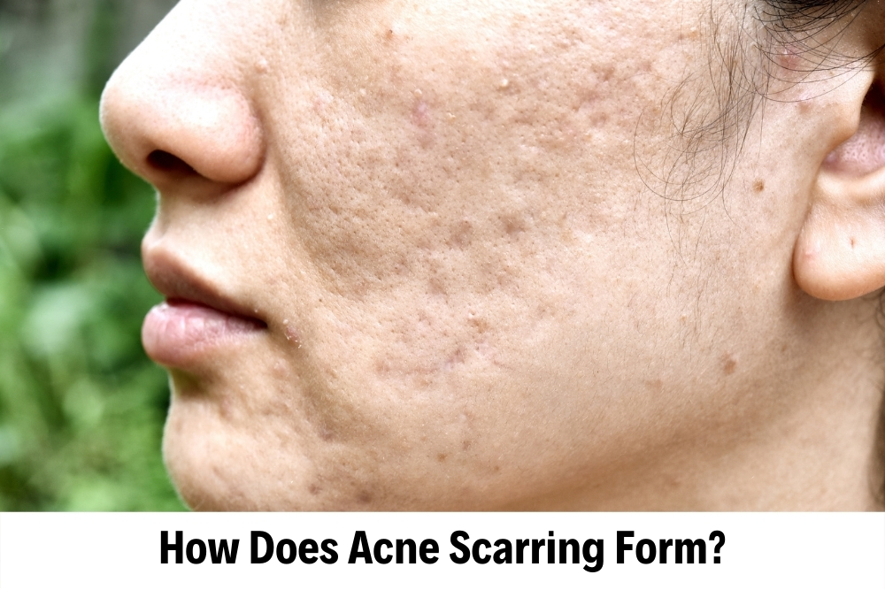 Acne Scars