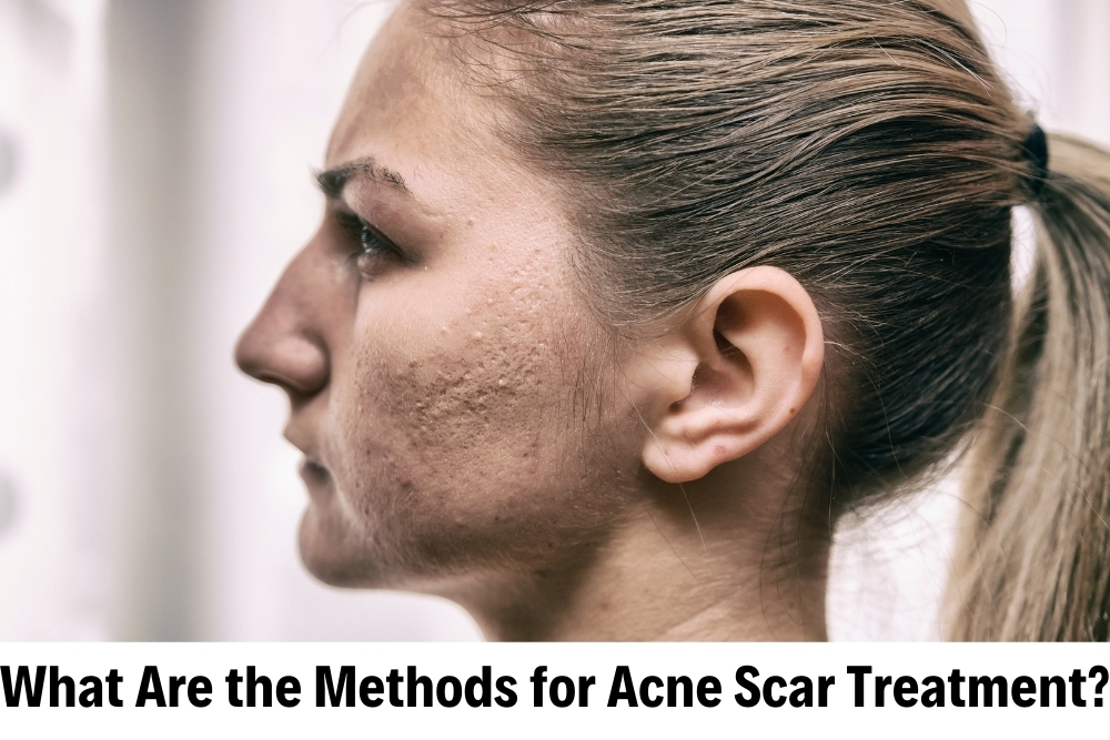 Acne Scars