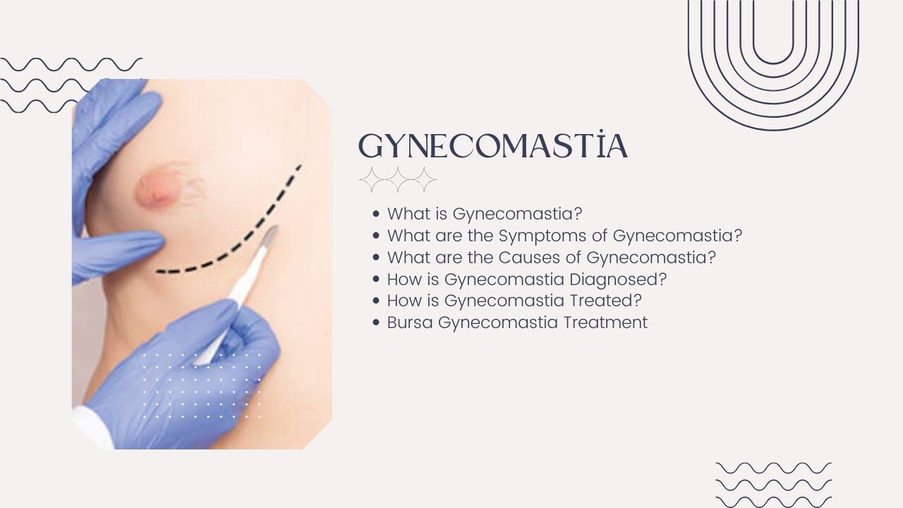 Gynecomastia