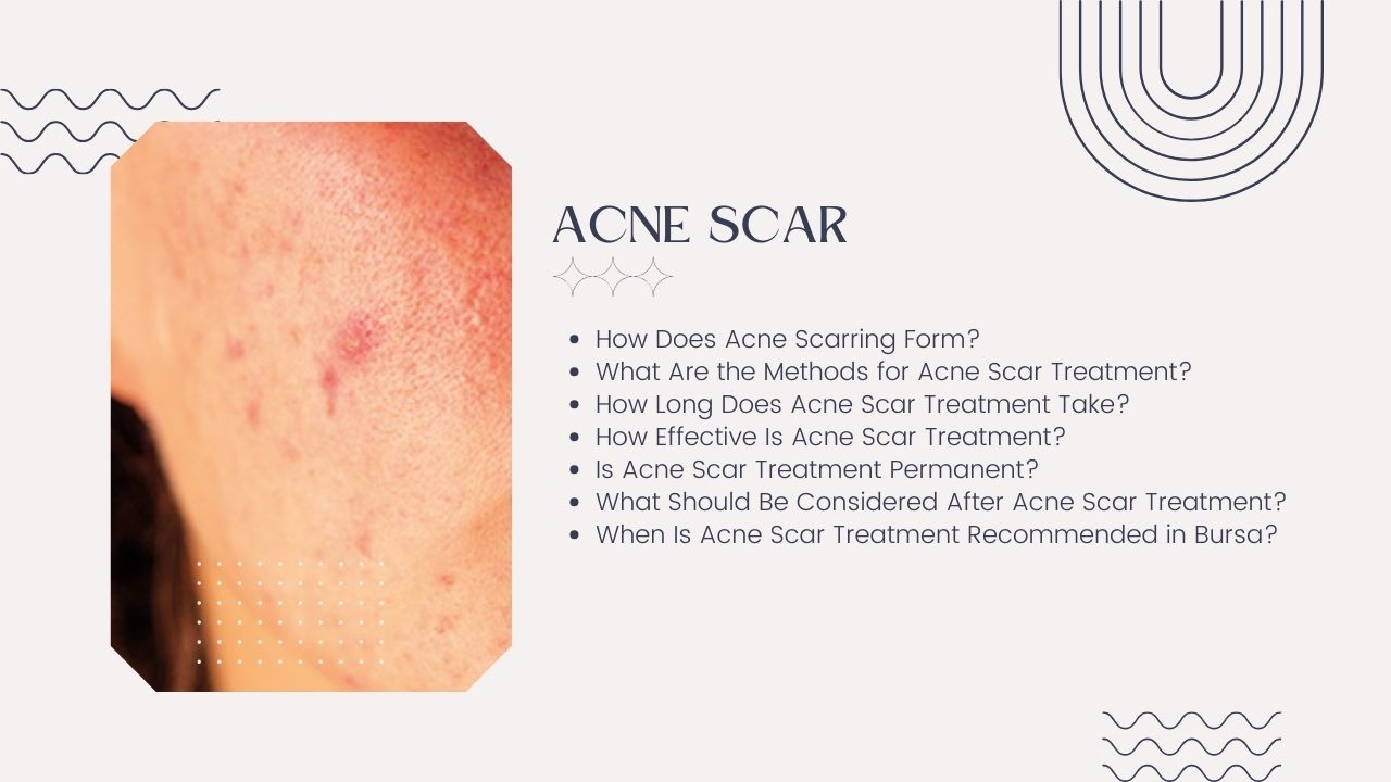 Acne Scars