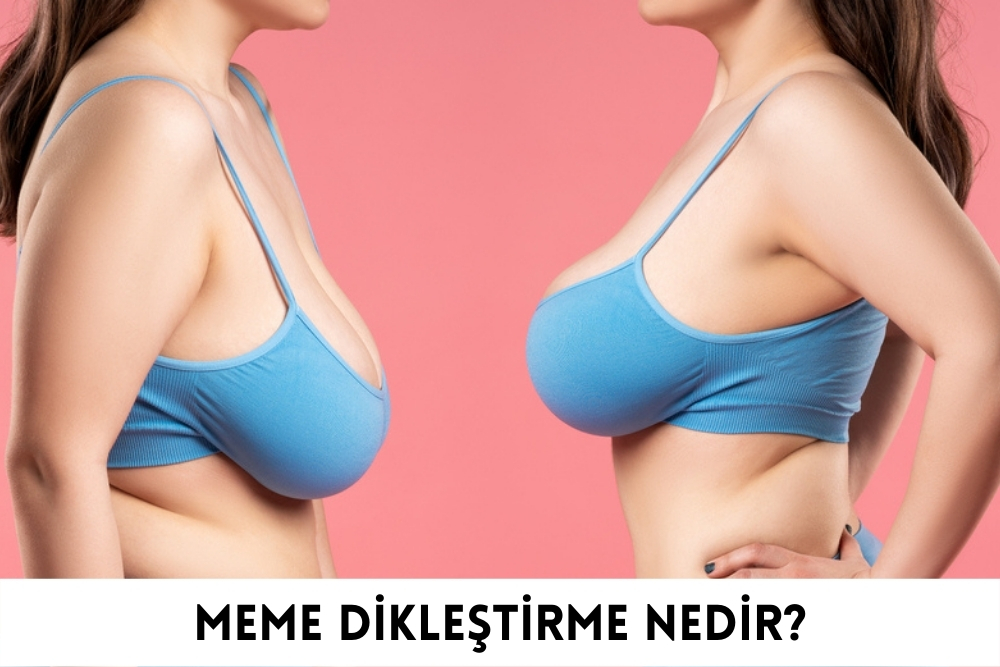 Meme Dikleştirme