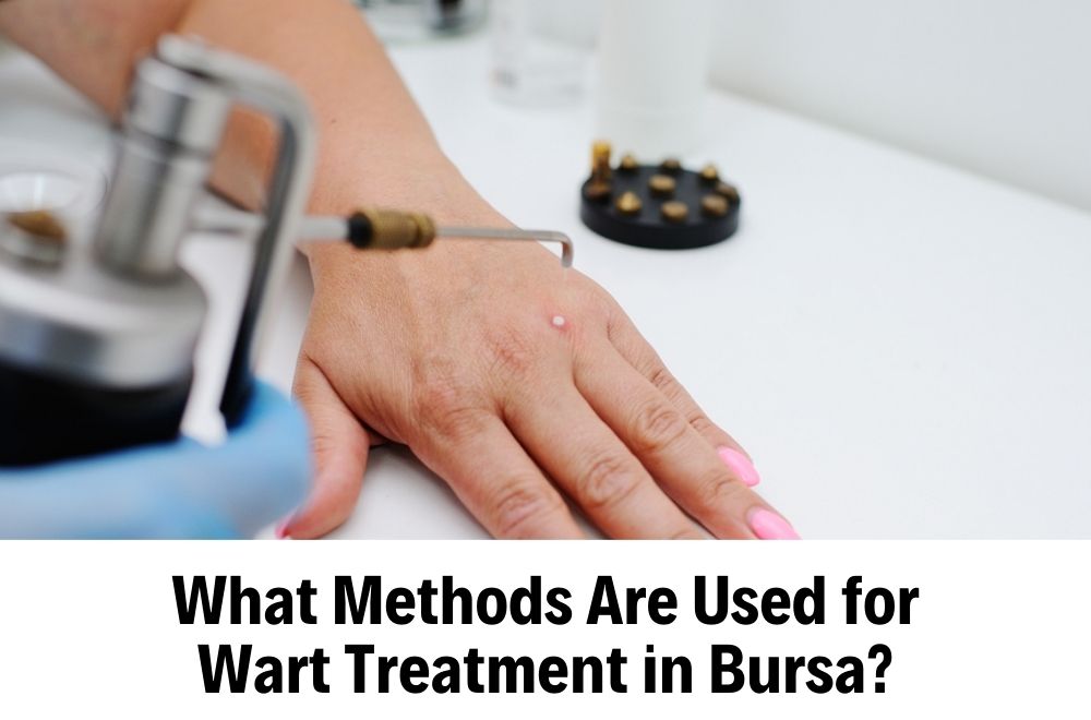 Wart Treatment