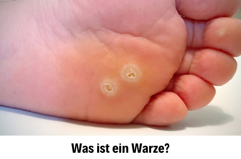 Warzenbehandlung